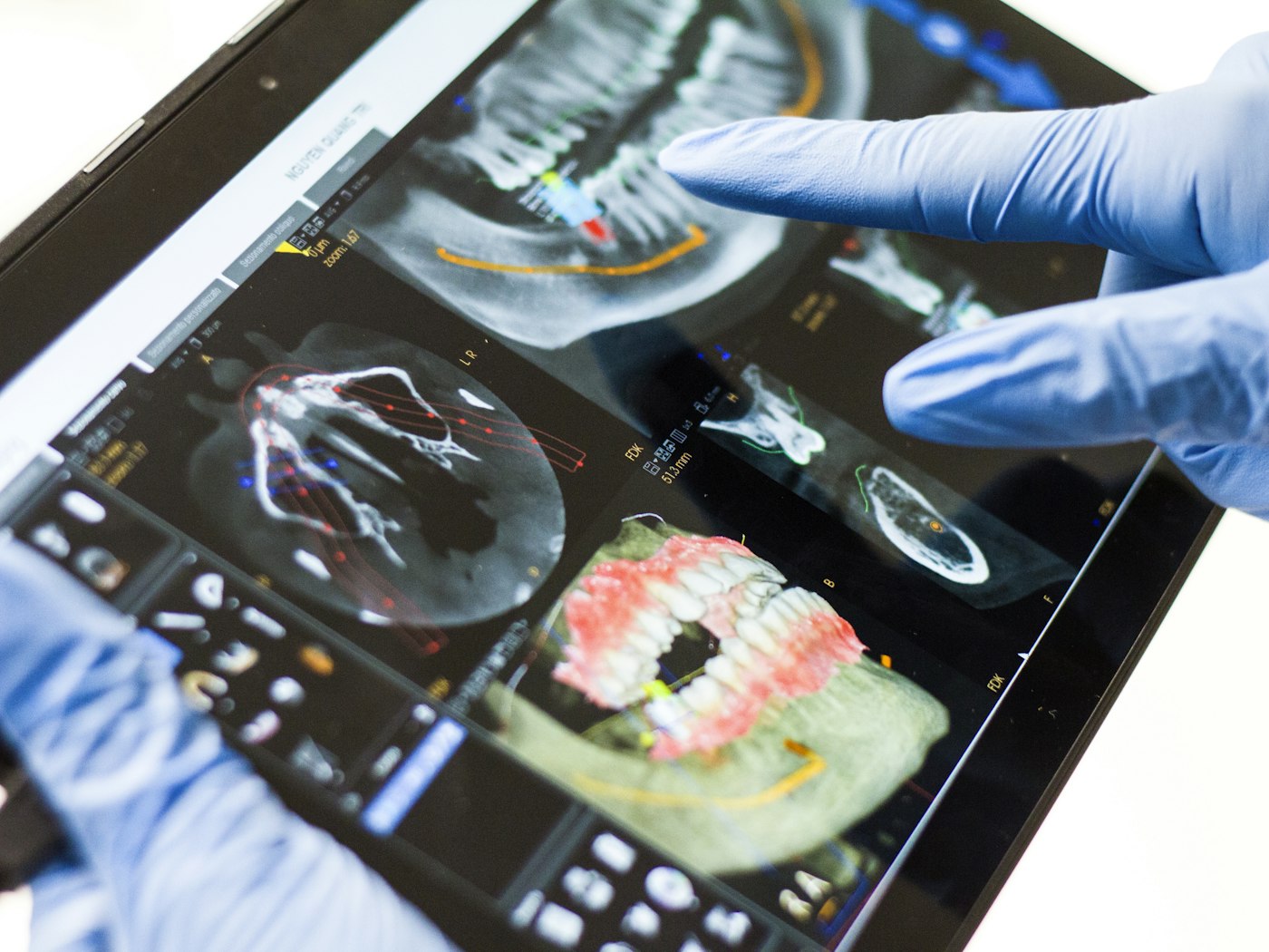 Computer-guided implants