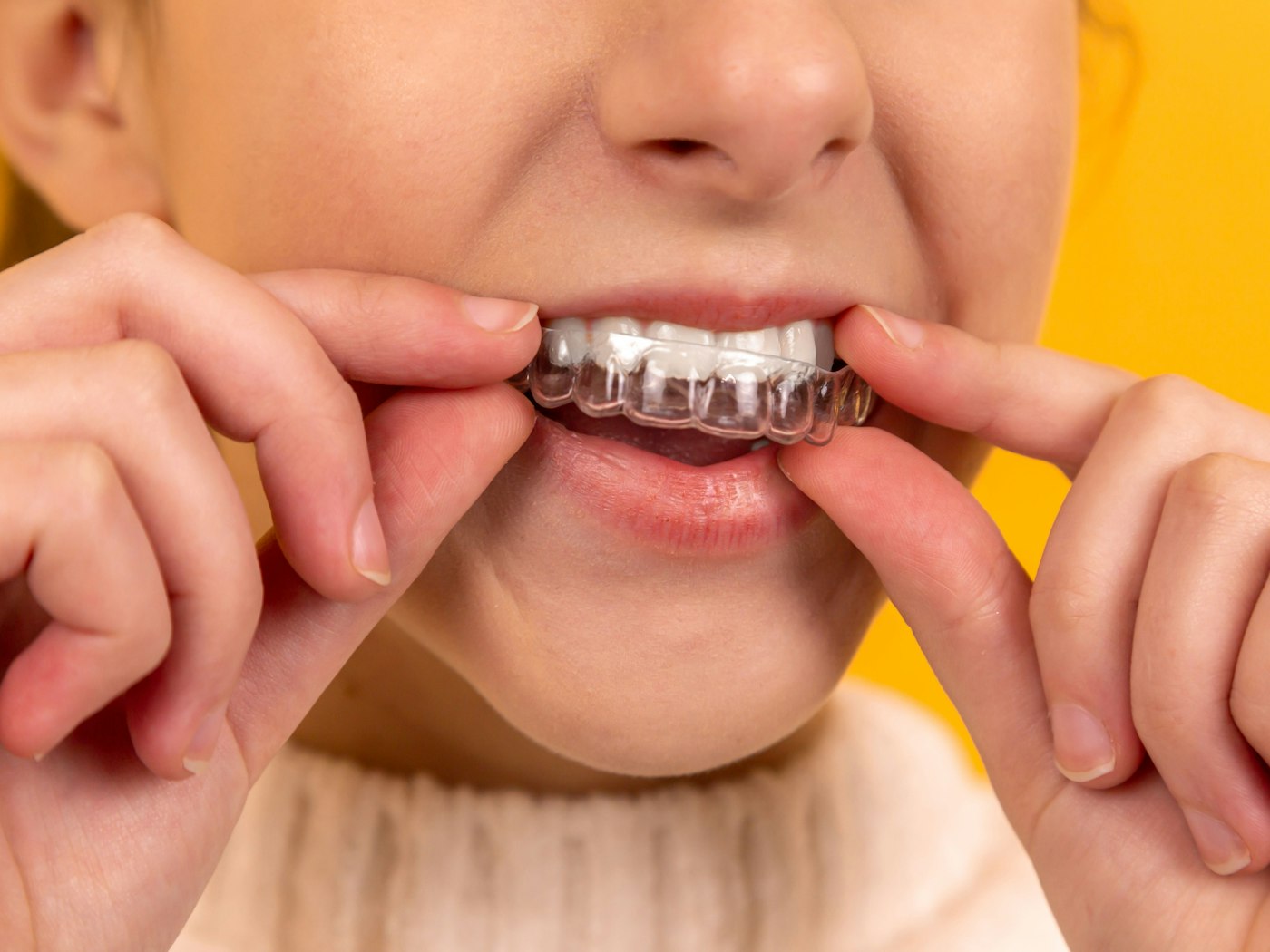 Patient placing a clear aligner
